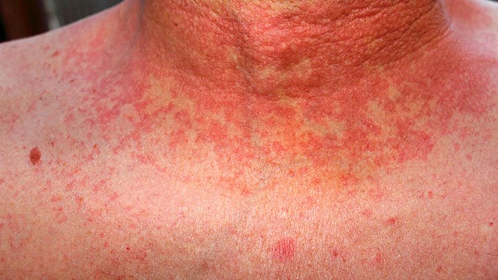 مخملک یا تب اسکارلت