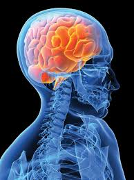 خونریزی مغزی، Cerebral hemorrhage خونریزی مغزی، Cerebral hemorrhage