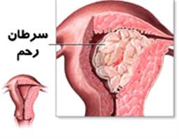 سرطان رحم