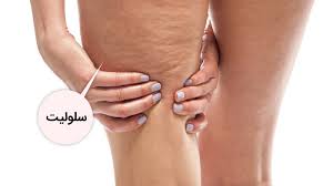 سلولیت (فرورفتگی ها و ناهمواری)