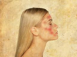 سندرم کارسینوئید سندرم کارسینوئید