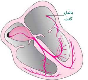 سندرم ولف پارکینسون وایت