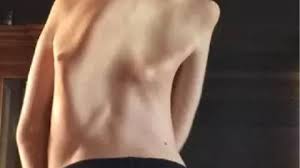 فیبرودیسپلازی استخوانیشونده پیشرونده فیبرودیسپلازی استخوانیشونده پیشرونده