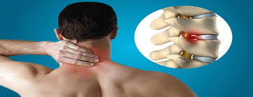 اسپوندیلوز ( مهره ستون فقرات ) اسپوندیلوز ( مهره ستون فقرات )