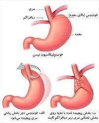 جراحی فوندوپلیکاسیون: راهکاری مؤثر برای درمان رفلاکس معده