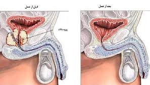 جراحی برای بزرگ شدن پروستات (Benign Prostatic Hyperplasia - BPH)
