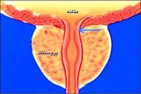 درد در ناحیه پروستات